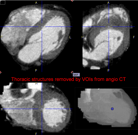 P3D Prepared Angio CT