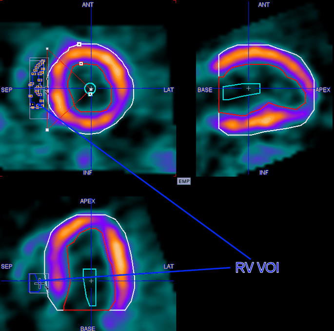 PCARD RV Isoconour